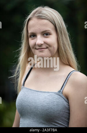 Emily Eccles, an ihrem Haus in Yorkshire, nachdem Sie erlitt eine der schlimmsten Gesichtsverletzungen ärzte gesehen haben, vor einem Krieg, in einem Reiten Unfall. Stockfoto