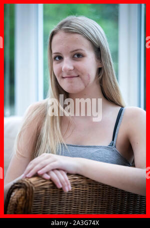 Emily Eccles, an ihrem Haus in Yorkshire, nachdem Sie erlitt eine der schlimmsten Gesichtsverletzungen ärzte gesehen haben, vor einem Krieg, in einem Reiten Unfall. Stockfoto