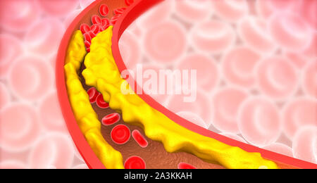 Arterie verstopft mit schlechtem Cholesterin. verstopfte Arterien, koronare Plaque. 3D-Darstellung Stockfoto