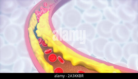 Arterie verstopft mit schlechtem Cholesterin. verstopfte Arterien, koronare Plaque. 3D-Darstellung Stockfoto