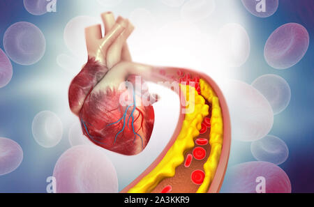 Cholesterin Plakette in der Arterie mit menschlichen Herzens Anatomie. 3D-Darstellung Stockfoto