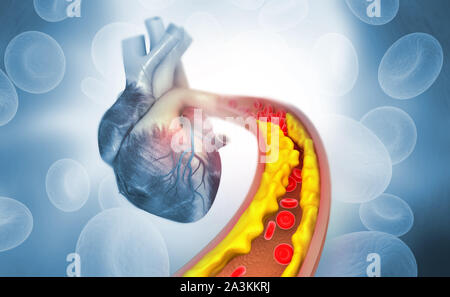 Cholesterin Plakette in der Arterie mit menschlichen Herzens Anatomie. 3D-Darstellung Stockfoto