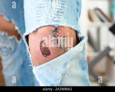 Wunde am Knie zerrissen Jeans Hosen Stockfoto