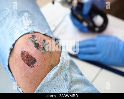 Der Arzt untersucht die heilende Wunde des Patienten auf dem Bein vom Knie zerrissen jeans Schrammen Stockfoto