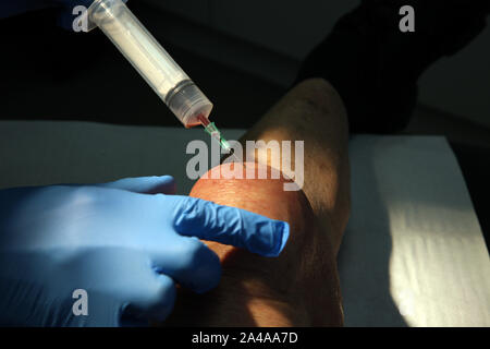 Bursitis Aspiration Stockfoto