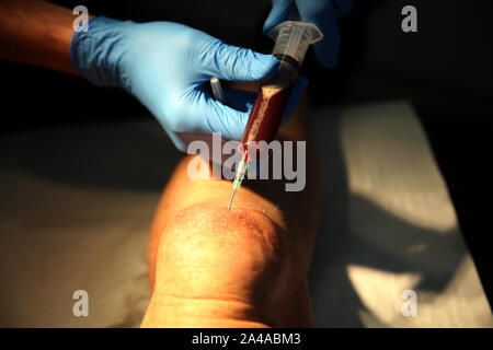 Bursitis Aspiration Stockfoto