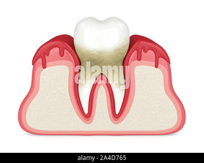 3D-Render von Zahn in Zahnfleischbluten auf weißen Hintergrund. Parodontitis Konzept. Stockfoto