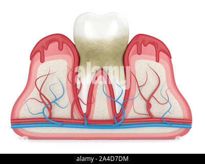 3D-Render von Zahn in Zahnfleischbluten auf weißen Hintergrund. Parodontitis Konzept. Stockfoto