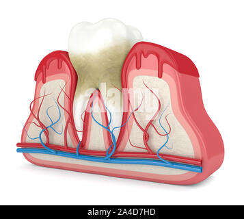 3D-Render von Zahn in Zahnfleischbluten auf weißen Hintergrund. Parodontitis Konzept. Stockfoto