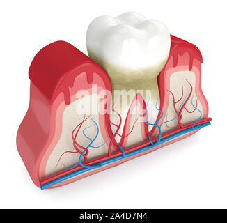 3D-Render von Zahn in Zahnfleischbluten auf weißen Hintergrund. Parodontitis Konzept. Stockfoto