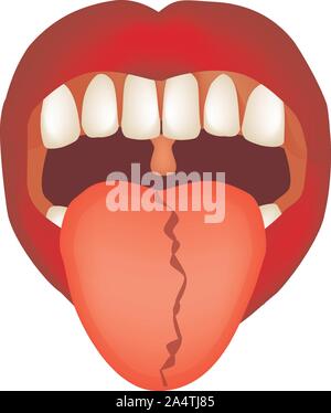 Krümmung von der Mittellinie der Zunge. Definition einer Krankheit nach der menschlichen Zunge. Diagnose durch die Zunge. Zunge Vector Illustration auf Stock Vektor