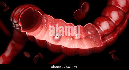 Peptisches Ulkus, 3D-Darstellung der menschlichen Magen Anatomie Stockfoto