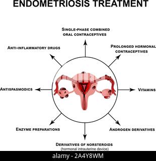 Behandlung der Endometriose. Adenomyose. Die Struktur der Beckenorgane mit einer Endometriose. Infografiken. Vector Illustration auf isolierte Stock Vektor