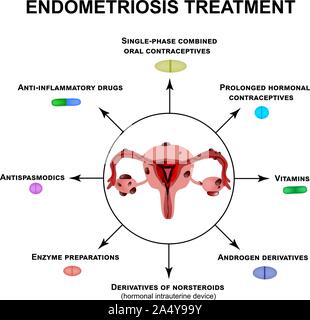 Behandlung der Endometriose. Adenomyose. Die Struktur der Beckenorgane mit einer Endometriose. Infografiken. Vector Illustration auf isolierte Stock Vektor