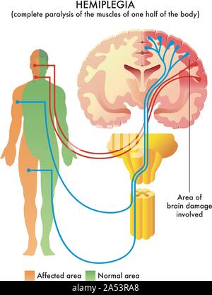 Detaillierte anatomische Abbildung der medizinischen Zustand genannt Hemiplegie. Stock Vektor