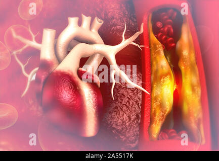 Cholesterin Plakette in der Arterie mit menschlichen Herzens Anatomie. 3D-Darstellung Stockfoto