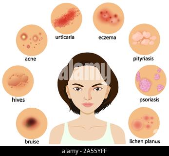 Diagramm mit verschiedenen Hauterkrankungen Abbildung Stock Vektor