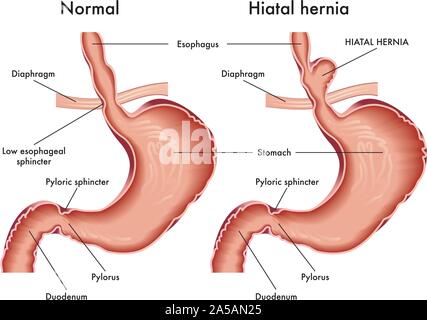 Medizinische Illustration der Magen mit hiatal Hernie mit Beschriftung. Stock Vektor