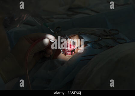 Die Cochlear Implantation Chirurgie Operation in der Medizinischen Klinik in Astrachan, Russland Stockfoto