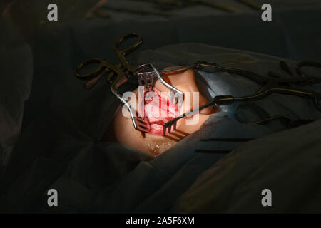 Die Cochlear Implantation Chirurgie Operation in der Medizinischen Klinik in Astrachan, Russland Stockfoto