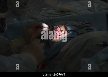 Die Cochlear Implantation Chirurgie Operation in der Medizinischen Klinik in Astrachan, Russland Stockfoto