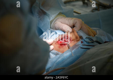 Die Cochlear Implantation Chirurgie Operation in der Medizinischen Klinik in Astrachan, Russland Stockfoto