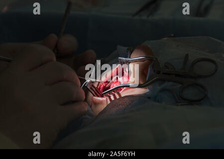 Die Cochlear Implantation Chirurgie Operation in der Medizinischen Klinik in Astrachan, Russland Stockfoto