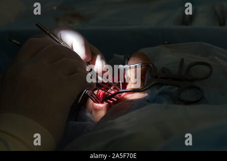 Die Cochlear Implantation Chirurgie Operation in der Medizinischen Klinik in Astrachan, Russland Stockfoto