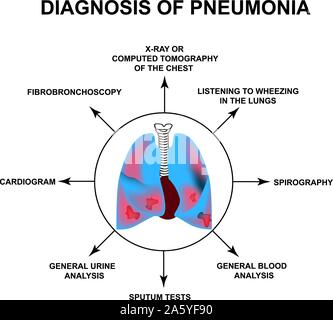 Diagnostik der Pneumonie. Menschlichen Atmungsorgane. Welt Pneumonie Tag. Die anatomische Struktur der entzündete Lunge. Infografiken. Vector Illustration Stock Vektor