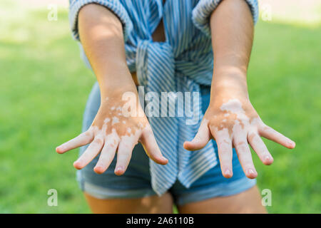 Detail der Hände eines Mädchens mit Haut depigmentierung oder Vitiligo Stockfoto