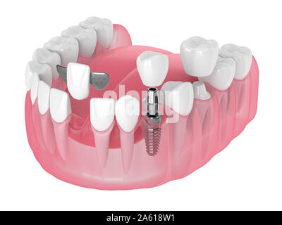 3D-Render von Kiefer mit dentalen Implantaten und Brücken über weißen Hintergrund Stockfoto