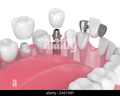 3D-Render von Kiefer mit dentalen Implantaten und Brücken über weißen Hintergrund Stockfoto