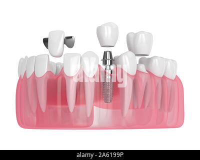 3D-Render von Kiefer mit dentalen Implantaten und Brücken über weißen Hintergrund Stockfoto