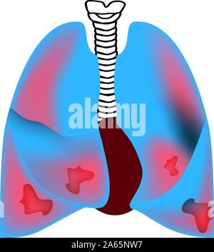 Der lunge durch Pneumonie betroffen. Welt Pneumonie Tag. Die anatomische Struktur der Lunge. Infografiken. Vector Illustration auf isolierte Hintergrund. Stock Vektor