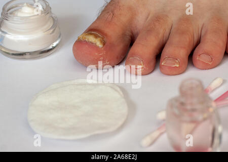 Zehennagel durch den Pilz betroffen. Nagelpflege. Die Creme in eine jar, Wattepads, Wattestäbchen. Selektive konzentrieren. Weißer Hintergrund. Stockfoto