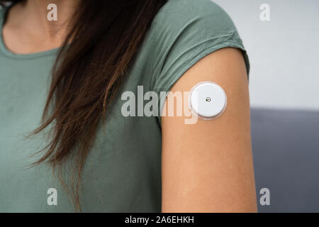 Nahaufnahme einer Frau Test Glucose Level mit einem kontinuierlichen Glucose Monitor auf Ihrem Arm Stockfoto