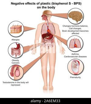 Bisphenol s Effekte auf den menschlichen Körper 3 d medical Vector Illustration auf weißem Hintergrund Stock Vektor