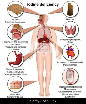 Jodmangel 3d medical Vector Illustration auf weißem Hintergrund eps 10 Infografik Stock Vektor