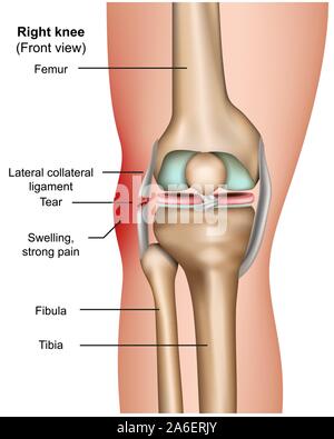 Seitliche Sicherheiten reißen 3 d medical Vektor Infografik auf weißem Hintergrund Stock Vektor
