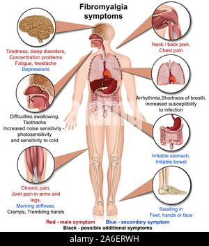 Fibromyalgie Symptome medizinische Vector Illustration auf weißem Hintergrund Infografik Stock Vektor