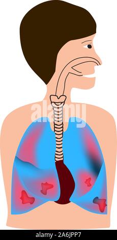 Lungen durch Tuberkulose, Bronchitis betroffen. Der menschlichen Atemwege. Welt Pneumonie Tag. Die anatomische Struktur der entzündete Lunge. Infografiken Stock Vektor