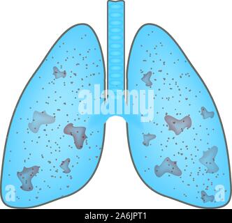 Der lunge durch Pneumonie betroffen. Welt Pneumonie Tag. Die anatomische Struktur der Lunge. Infografiken. Vector Illustration auf isolierte Hintergrund. Stock Vektor