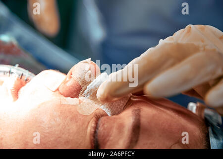 Rhinoplastik close-up. Ein Team von mehreren Ärzten führt Nase Chirurgie. Gebogene Septum, Atembeschwerden, Rhinoplastik. Stockfoto