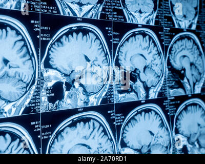 Die Magnetresonanztomographie (MRT) des Gehirns Stockfoto