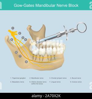 Mandibularnerv blockieren. Abbildung: Referenz der Unterkiefer Bereich Ästhetik Zahnarzt gerade Einspritzung, der Schmerz von Zähne Nerven zu stoppen. Stock Vektor