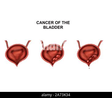 Das Wachstum von Tumoren der Blase Stockfoto