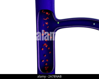 Arterie mit einem abgetrennten Bereichs, hochwertige Rendering mit original Texturen und Global Illumination, Kontraktion der Blutgefäße dargestellt Stockfoto