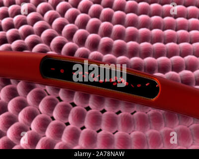 Arterie mit einem abgetrennten Bereichs, hochwertige Rendering mit original Texturen und Global Illumination, Kontraktion der Blutgefäße dargestellt Stockfoto