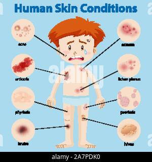 Diagramm mit verschiedenen Hauterkrankungen Abbildung Stock Vektor
