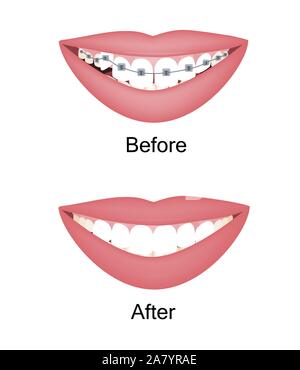 Frau krumme Zähne vor und nach der kieferorthopädischen Behandlung mit Zahnspangen. Vector Illustration isolierte Gruppe Stock Vektor